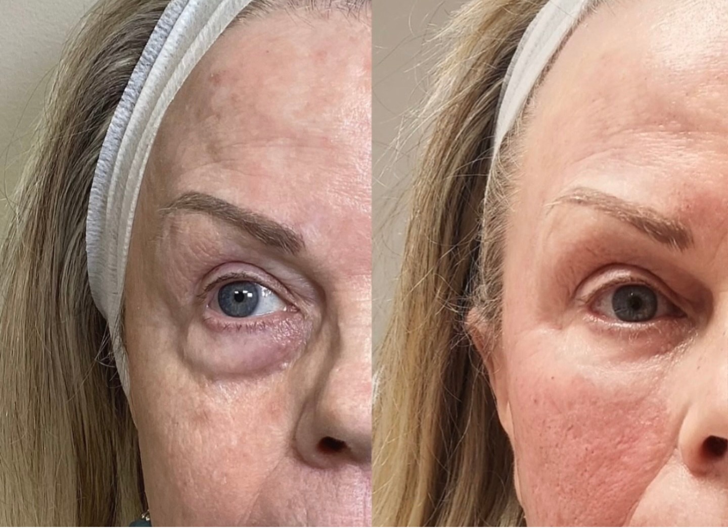 Skin rejuvenation before and after, Care Esthetics Delaware