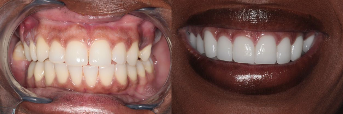 Before & After from Southern Dental Implant Center | Cordova, TN