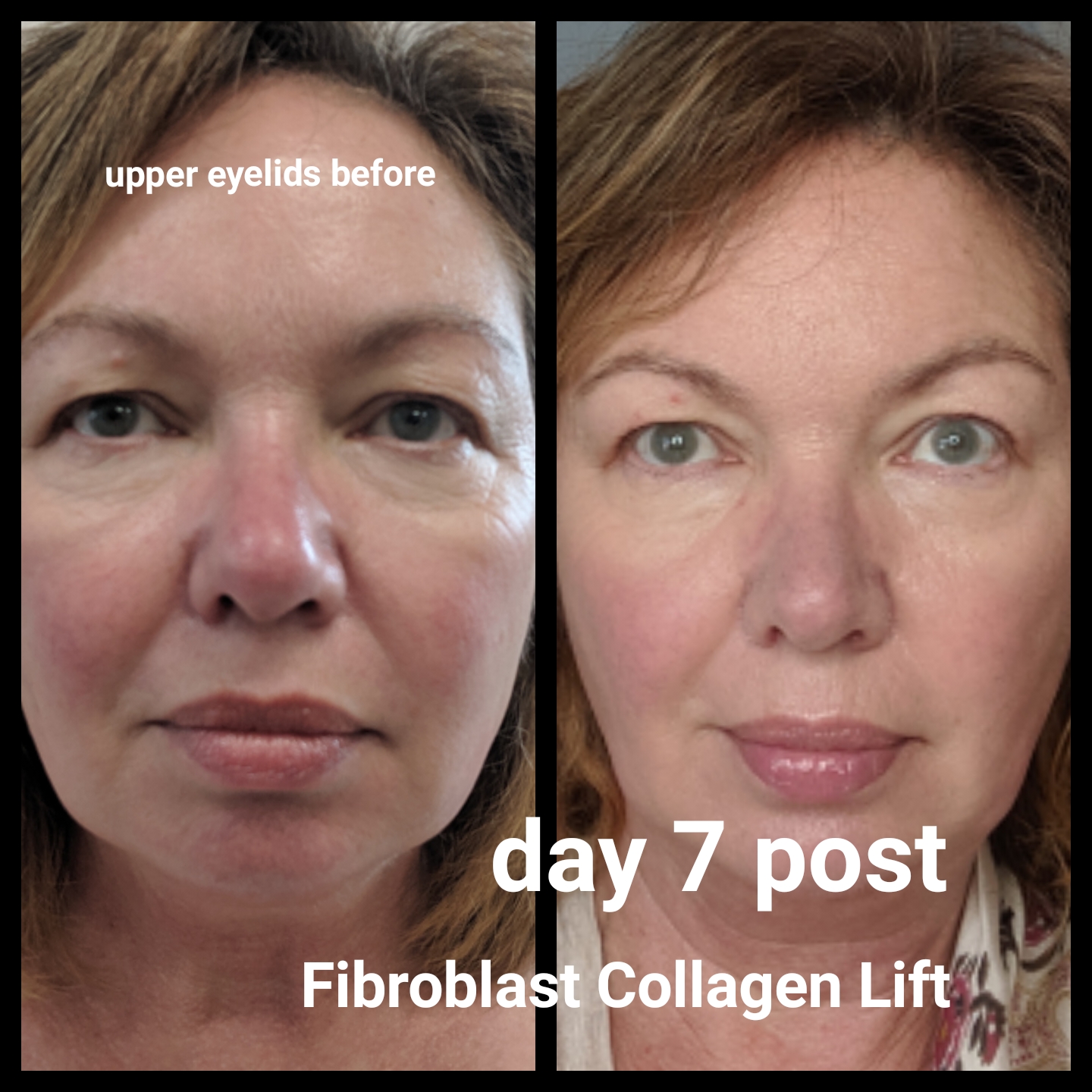 We do Fibroblast. Book your appointment today at 442-899-8819