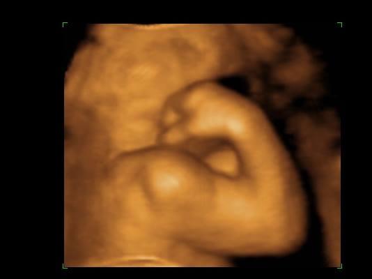 Belly 2 Birth 3D 4D Ultrasound Photo