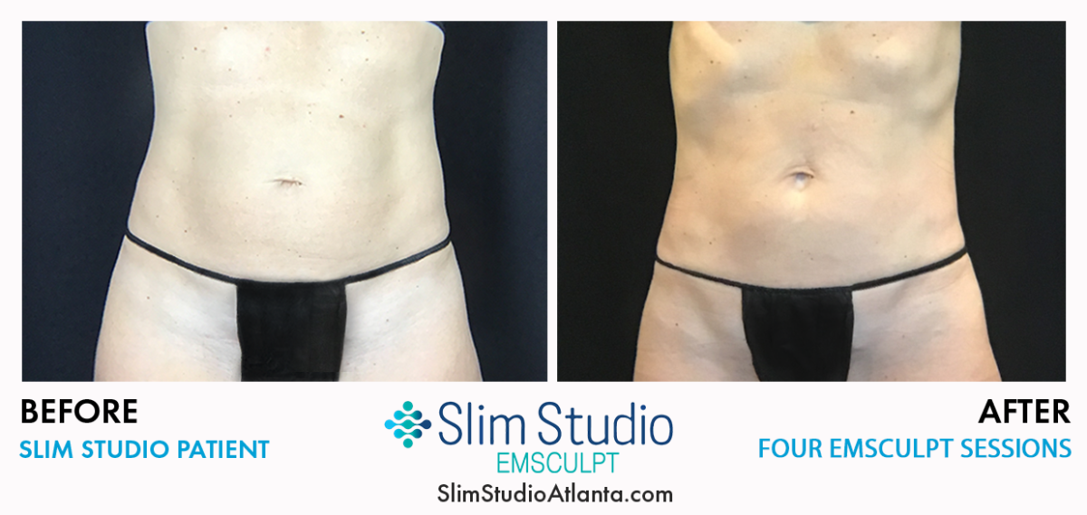 Slim Studio EMSCULPT & Coolsculpting Photo