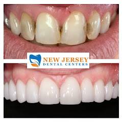 Before and after at NÜVA Smile | West New York, NJ