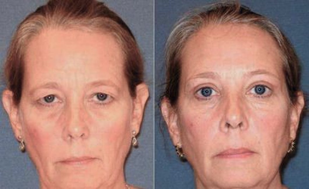 Before & After Results at Arizona Eye Institute & Cosmetic Laser Center | Sin City, AZ