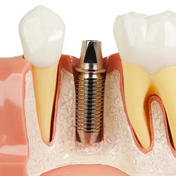 Image 4 | Premier Oral Surgery & Implantology Center