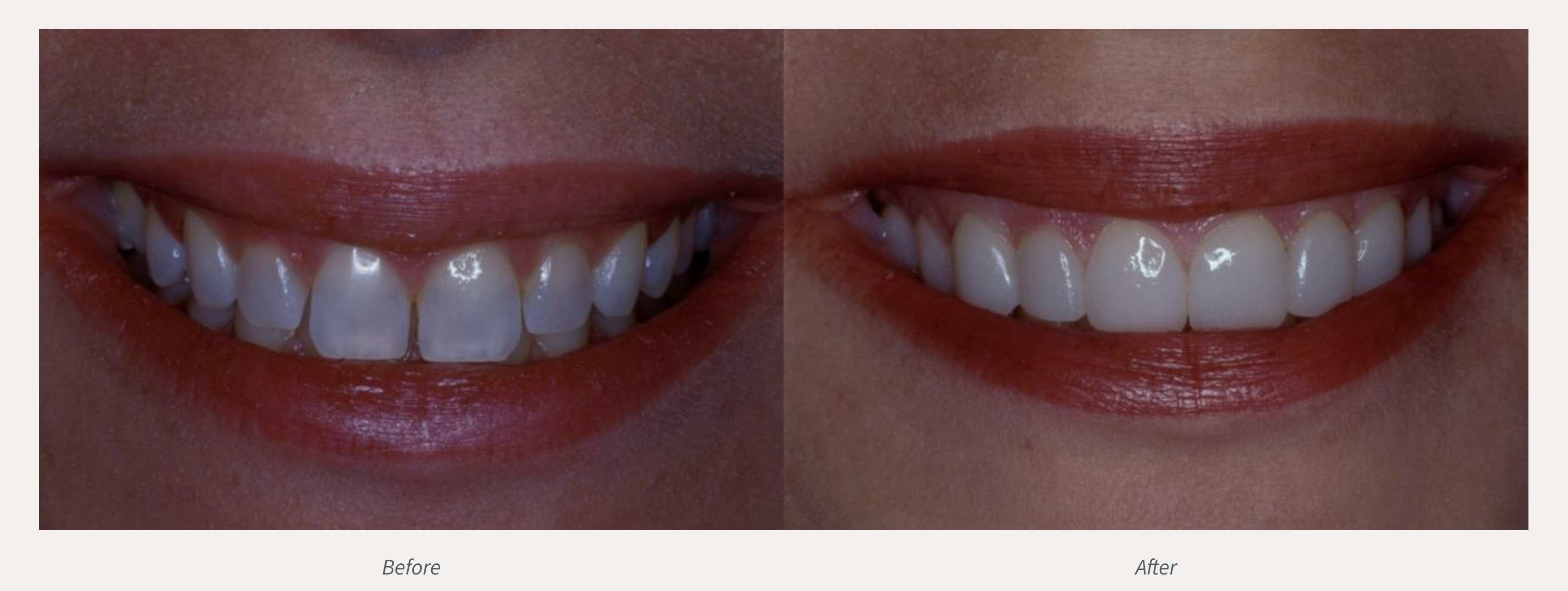 Porcelain Veneers Before & After from Advanced Dental Care | Valdosta, GA