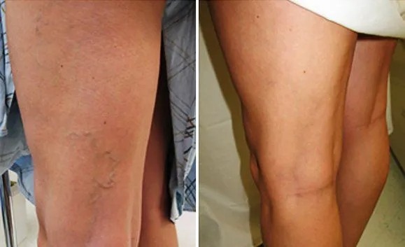 Northwest Vascular and Vein Specialists