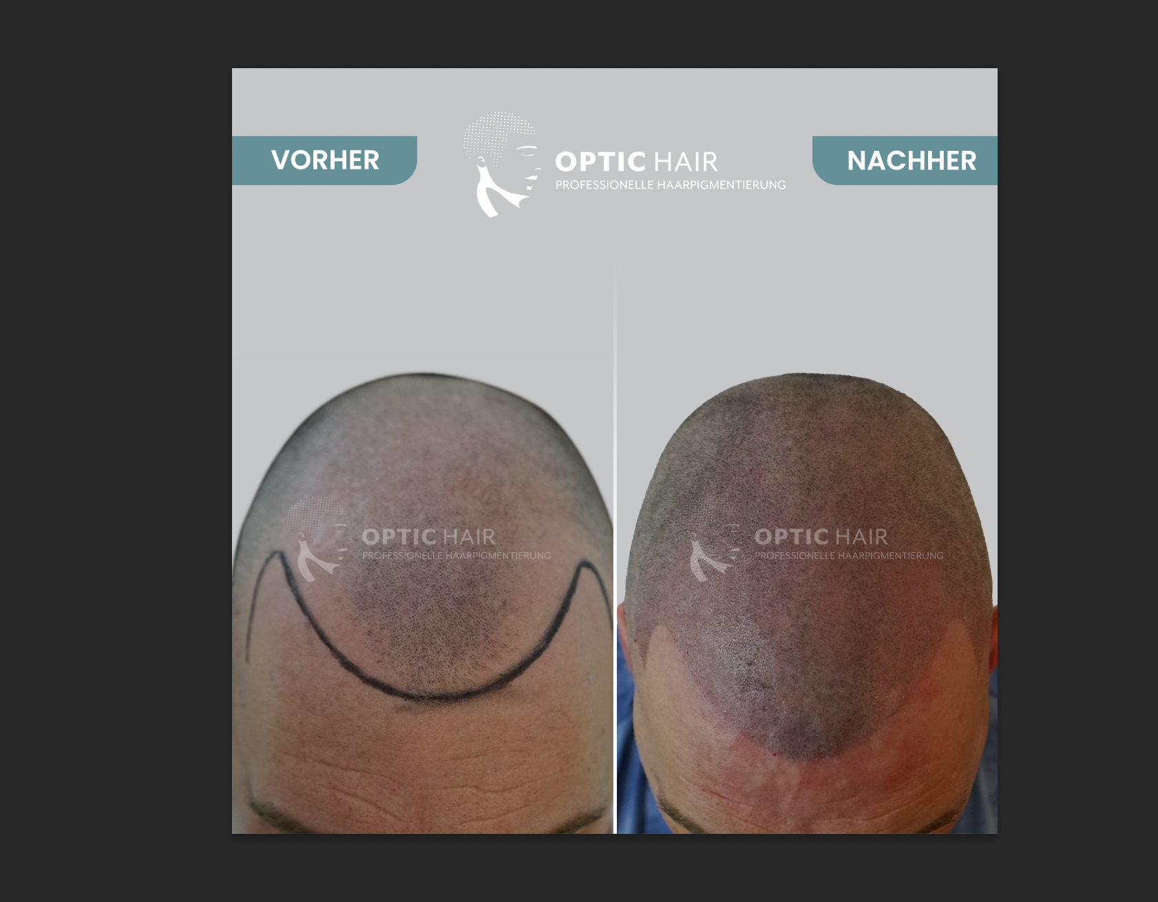Kundenfoto 7 Haarpigmentierung Köln | OpticHair