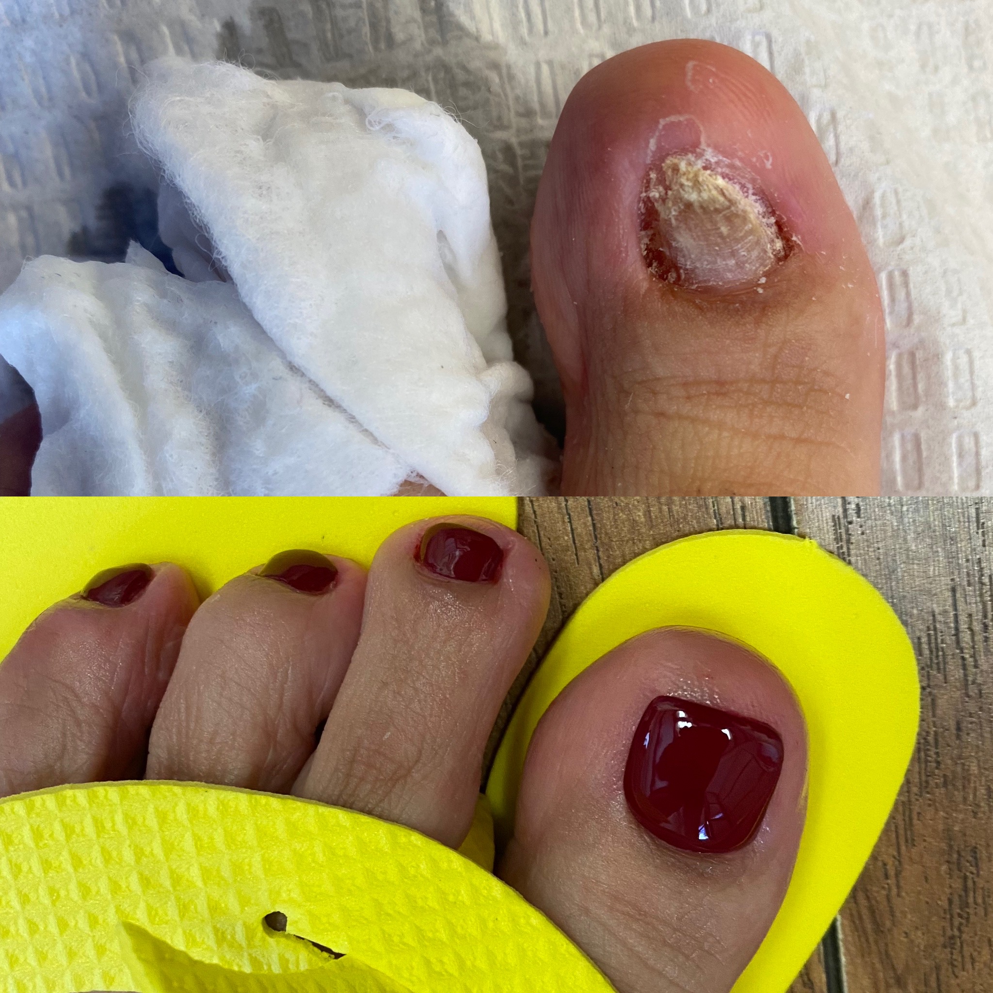 (Top) Before Keryflex treatment, toenail restoration