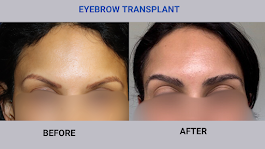Images BKS Hair Restoration