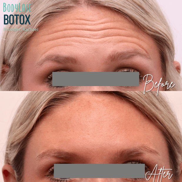 Images BodyLase Med Spa