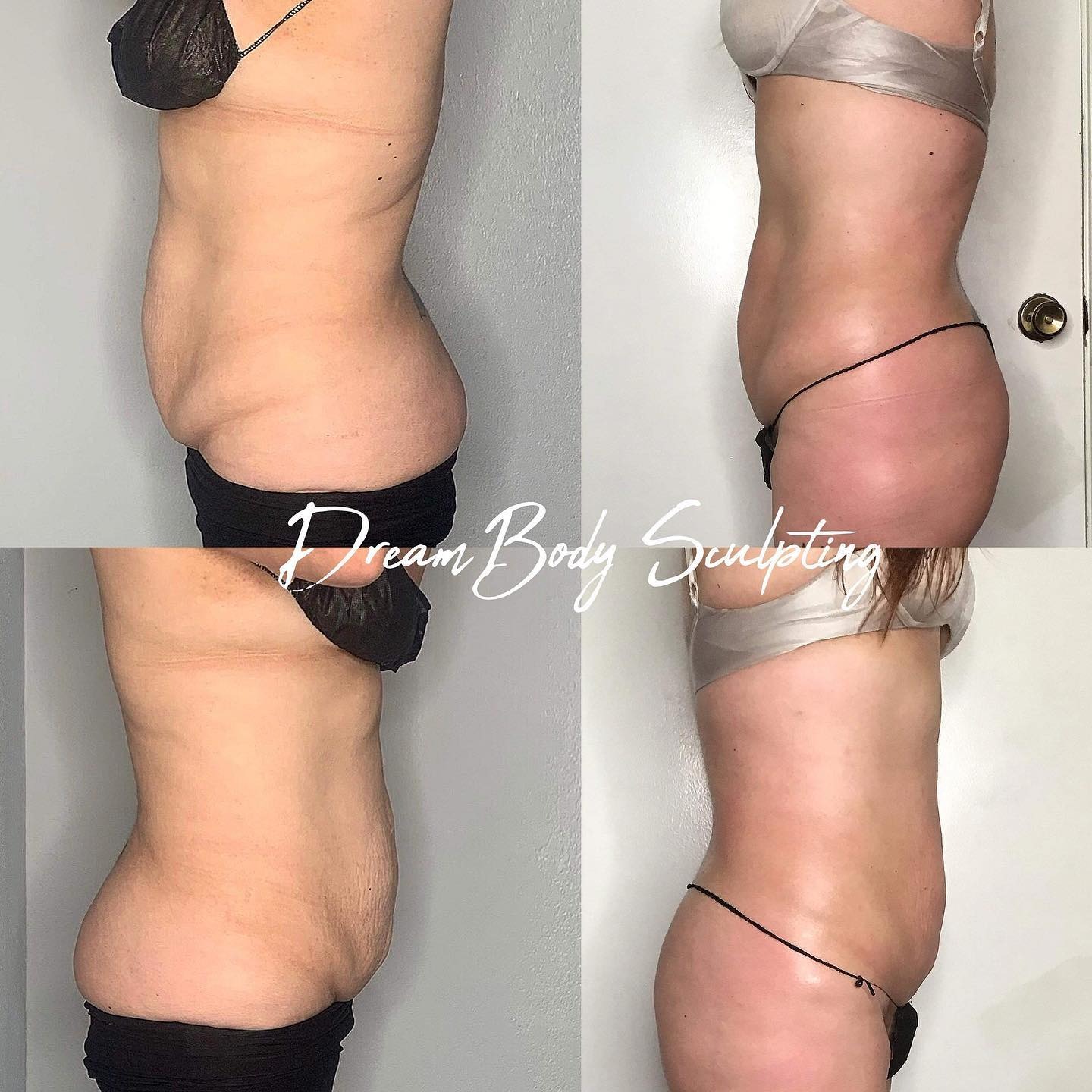 Before-and-after DreamBody Sculpting results showing reduced abdominal fullness and a slimmer, more contoured waistline following nonsurgical body contouring at Grace MedSpa in Austin, Texas.