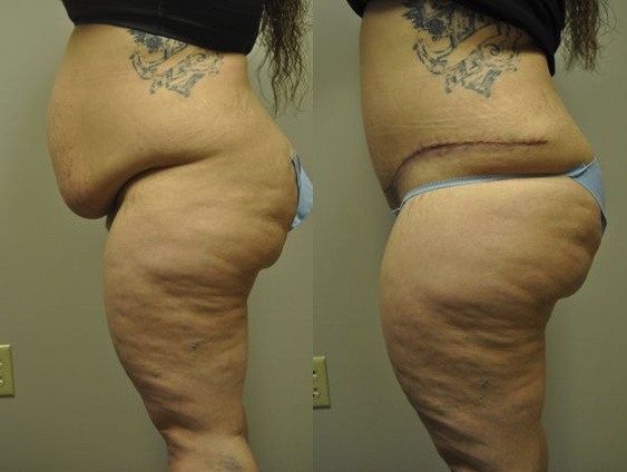 Before & After from H. Daniel Atwood, MD | Fayetteville, AR