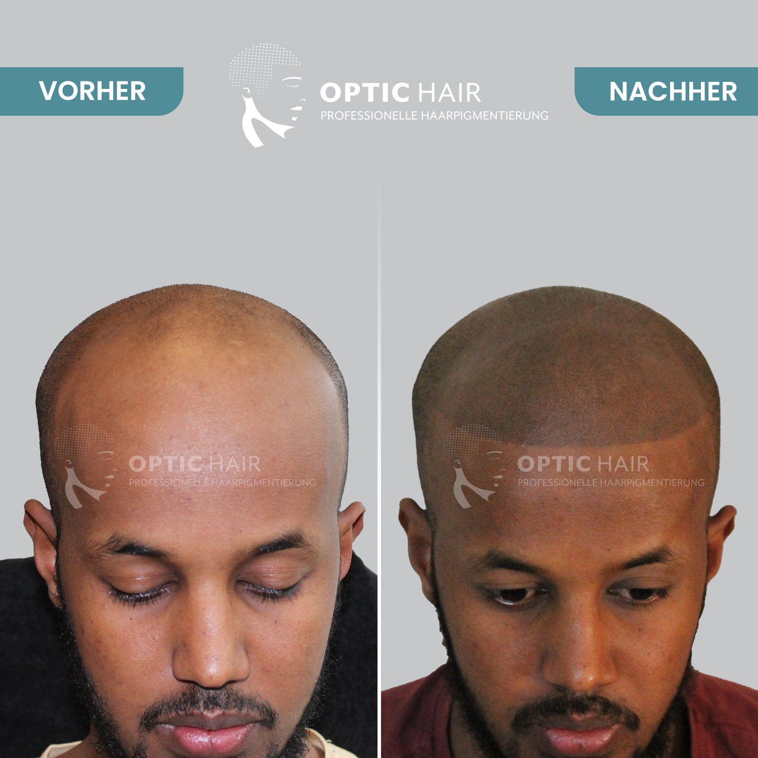 Bild 4 Haarpigmentierung Köln | OpticHair in Köln