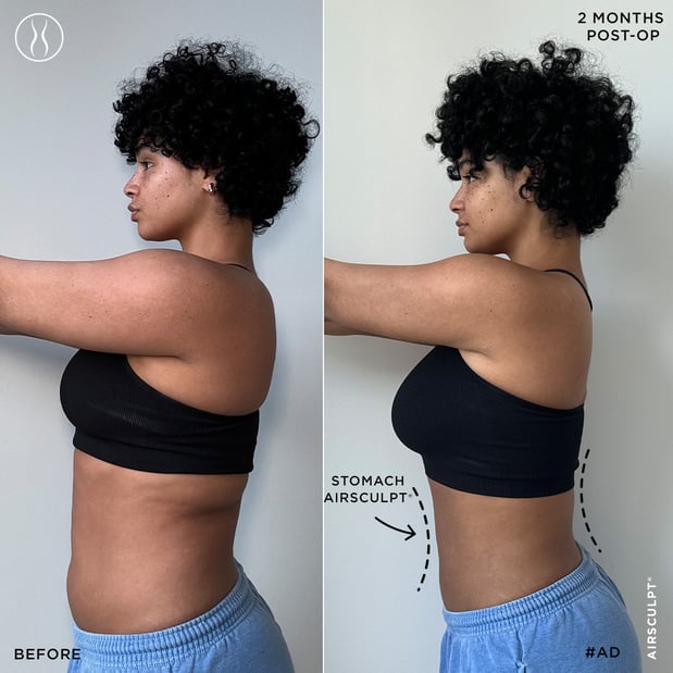 Images AirSculpt - Boston