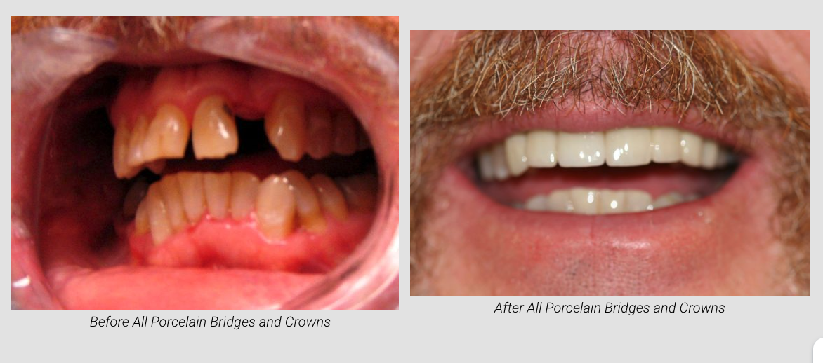 Smile Makeover Before & After at Lamendola Dentistry | Gonzales, LA