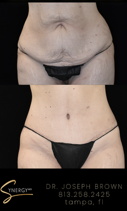 Before & After from SynergyMD Plastic Surgery | Tampa, FL