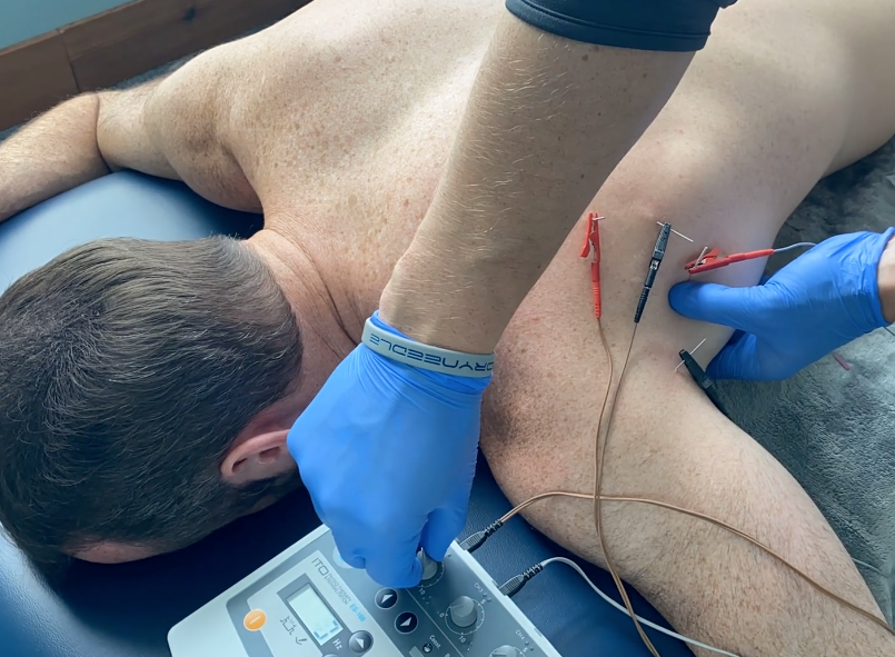 Upper Quadrant Dry Needling by ICE brings a modern approach to dry needling education with contemporary methods and tactical e-stim applications for the upper quadrant.