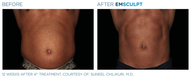 Images Columbus Emsculpt