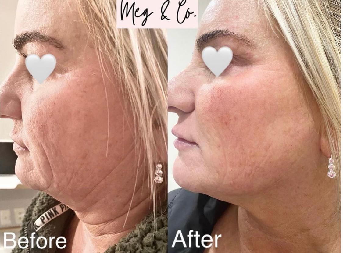 Before and after Genius Radio Frequency microneedling and LaseMD Ultra. Face and neck lifted, wrinkles significantly diminished and skin tone and texture evened out.