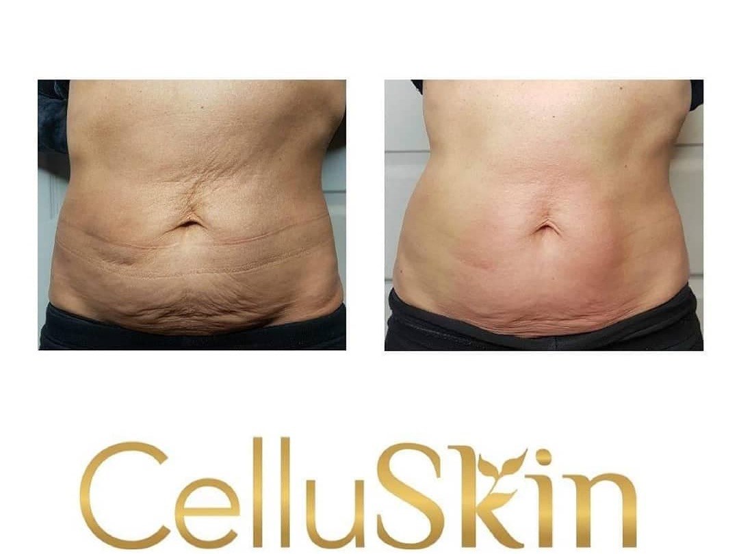 Images Onyx Esthétique - Soins esthétiques, Soins de la peau, Laser Cynosure Gatineau
