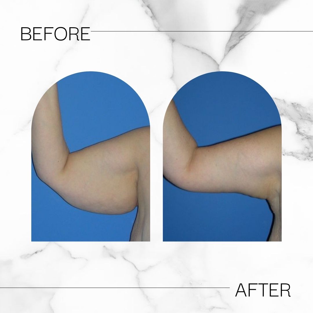 Before & After arm lift results at Devlin Cosmetic Surgery: Michael Devlin, M.D. | Little Rock, AR