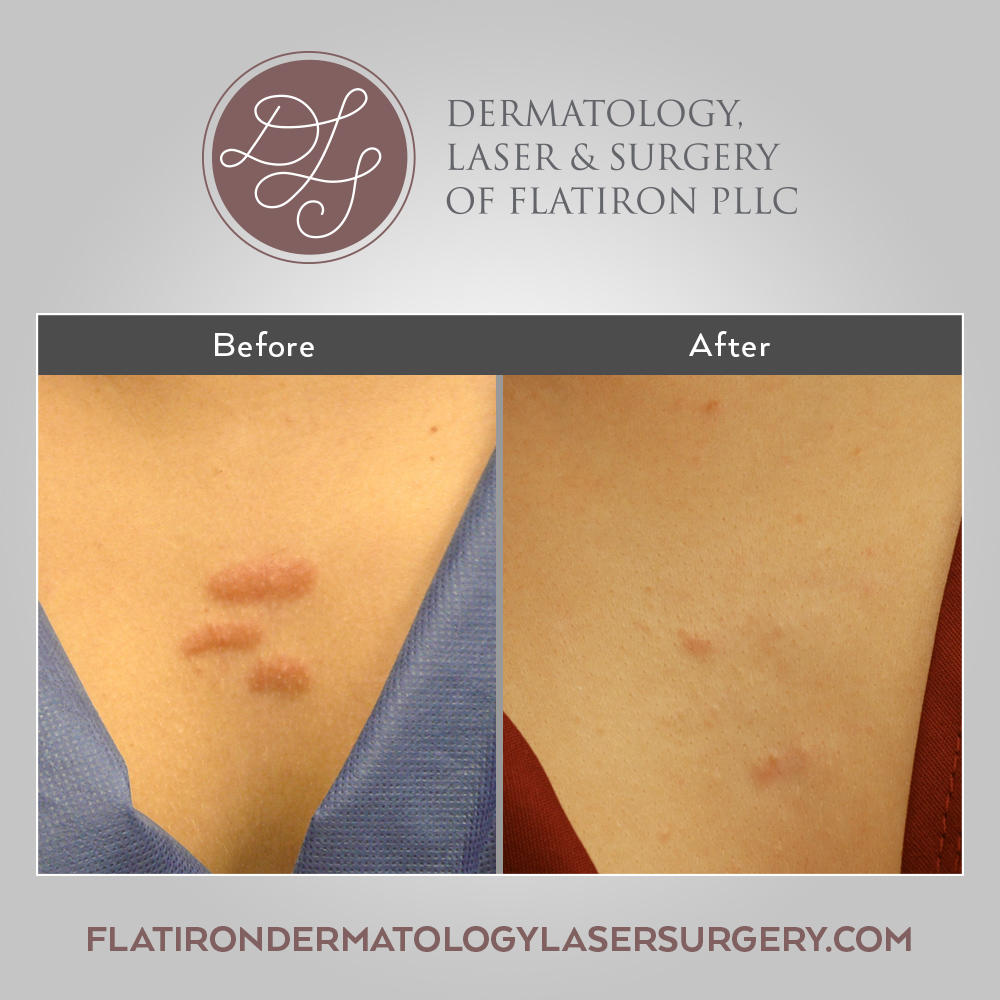 Dermatology, Laser & Surgery of Flatiron PLLC Photo