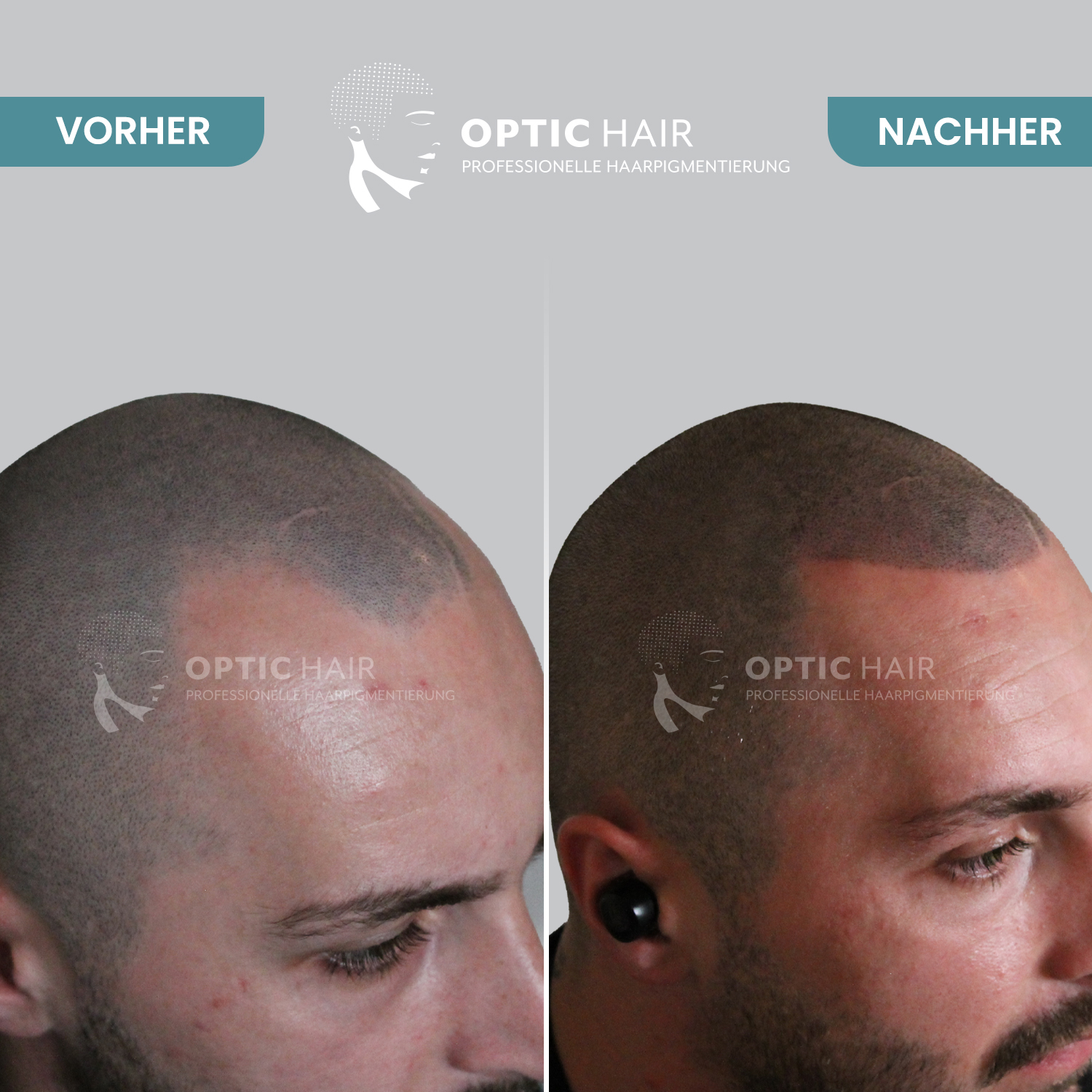 Bild 6 Haarpigmentierung Köln | OpticHair in Köln