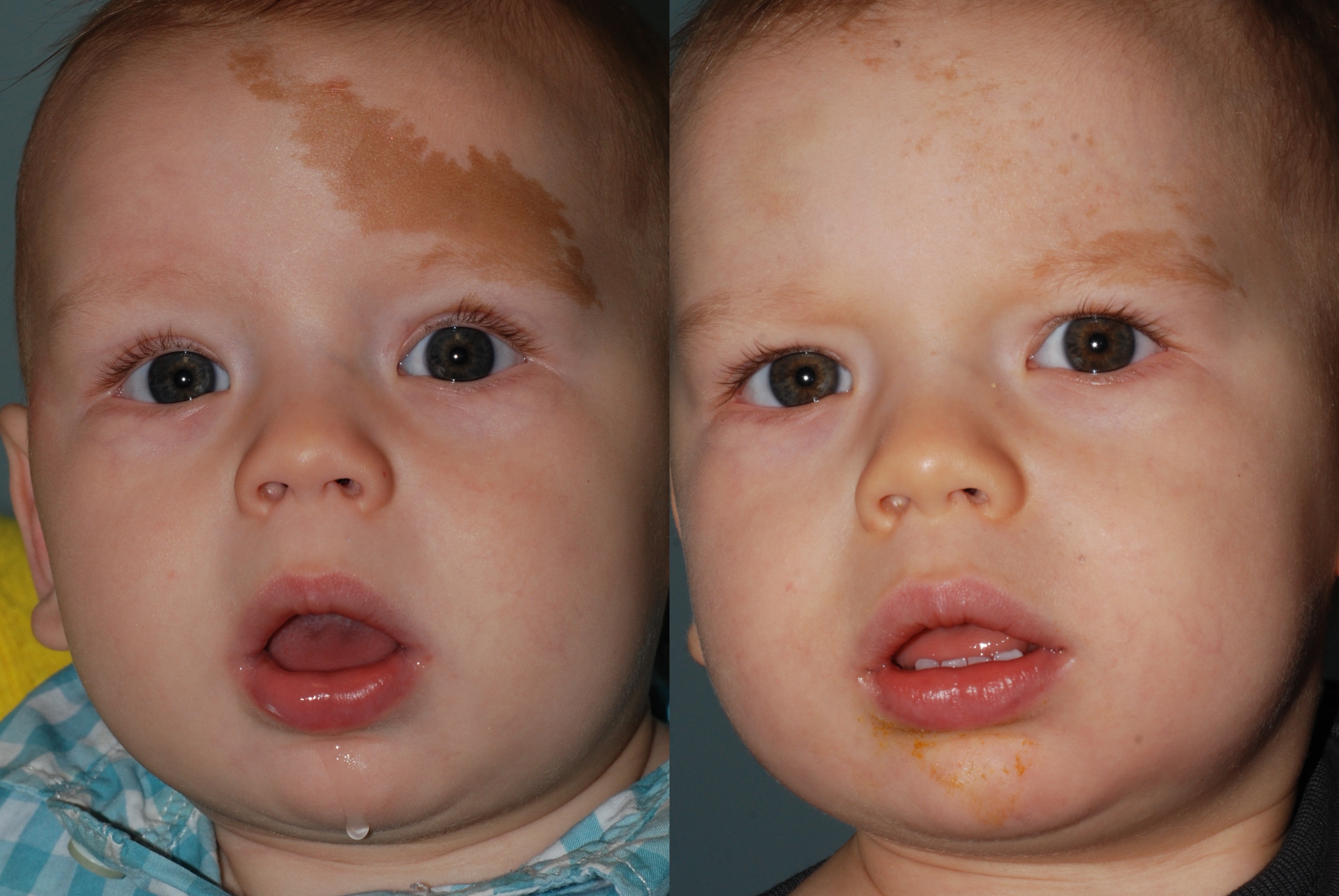 PicoSure treatment of brown birthmark in an infant.