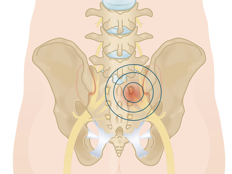 Cncrns_Cndtns-backpain-sciatic-392x294_@2x.jpg