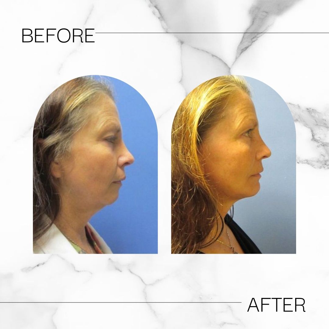 Before & After chin augmentation results at Devlin Cosmetic Surgery: Michael Devlin, M.D. | Little Rock, AR