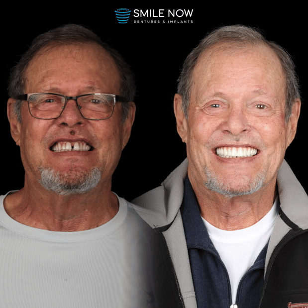 Images Smile Now Milwaukee Dentures and Implants