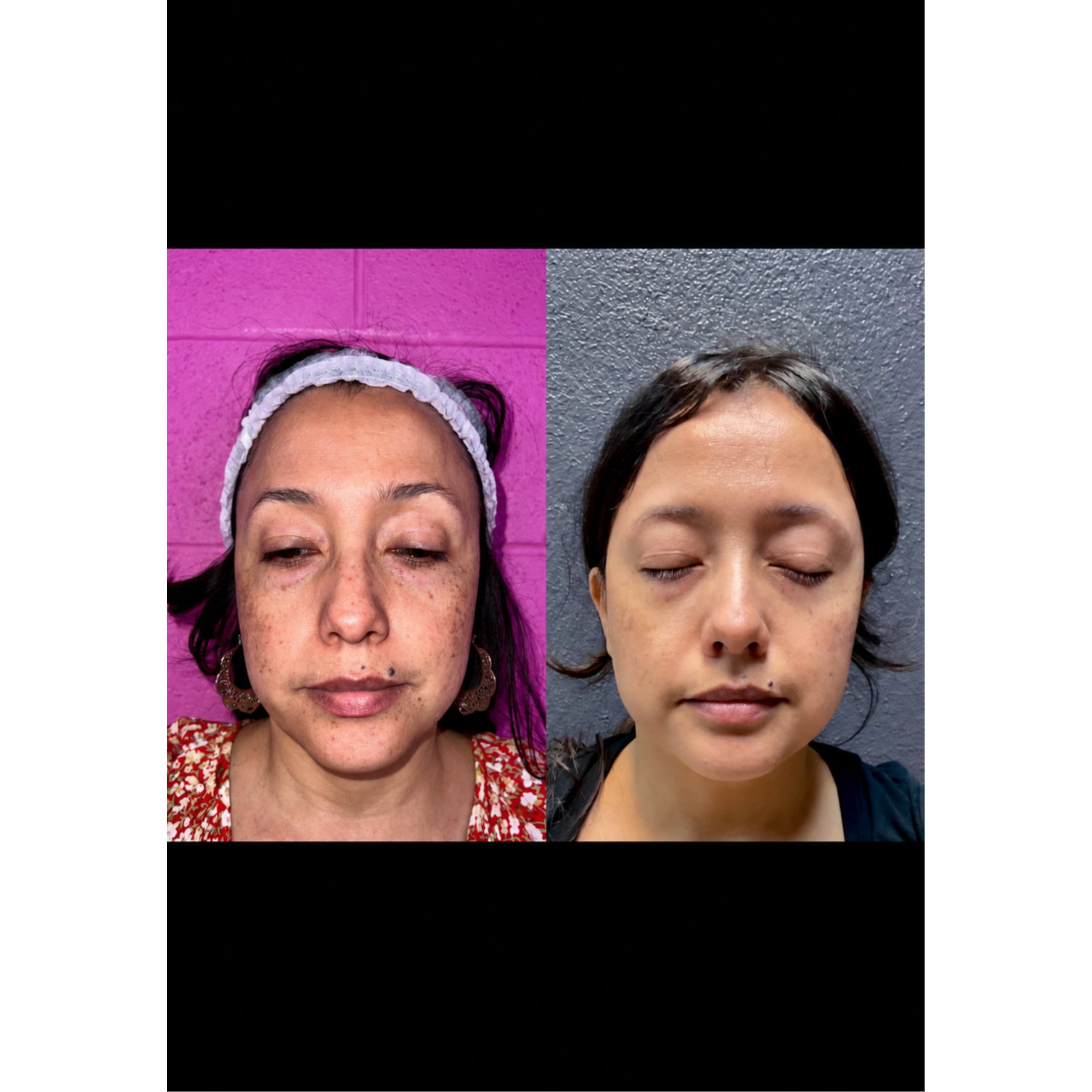 Before-and-after fractional laser resurfacing results showing visible improvement in melasma, uneven pigmentation and overall skin tone at Grace MedSpa in Austin, Texas.