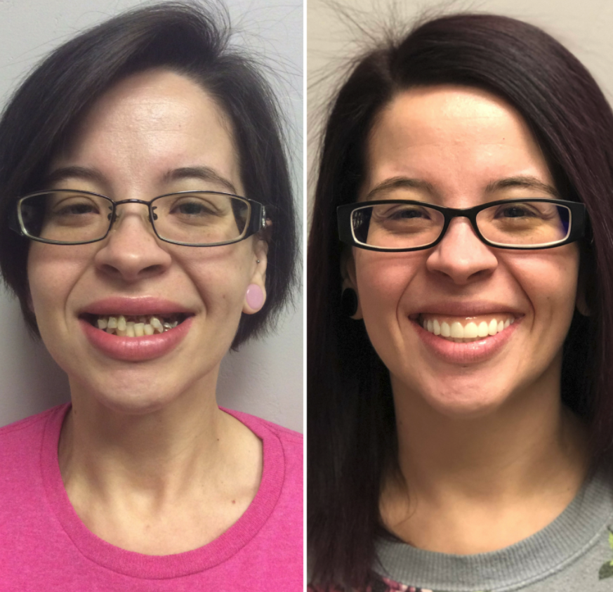 Before and After from Stubbs Dental | Layton, UT