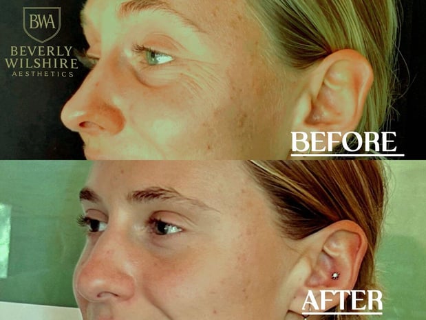 Images Beverly Wilshire Aesthetics Beverly Hills Medical Spa for Botox, Morpheus8, IPL, Lip Fillers