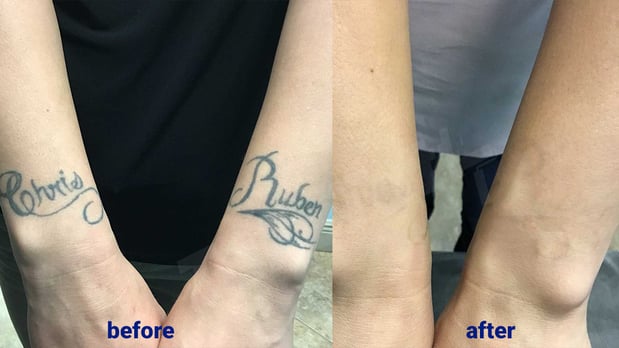 Images TakeTatt Tattoo Removal