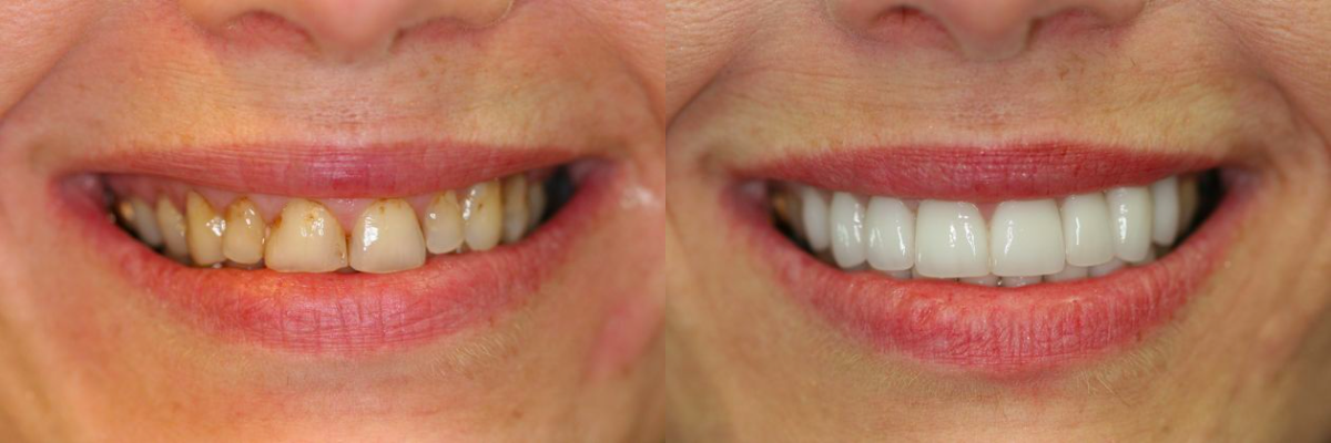 Before and After from Elite Dental Care | Eads, TN, , Dentist