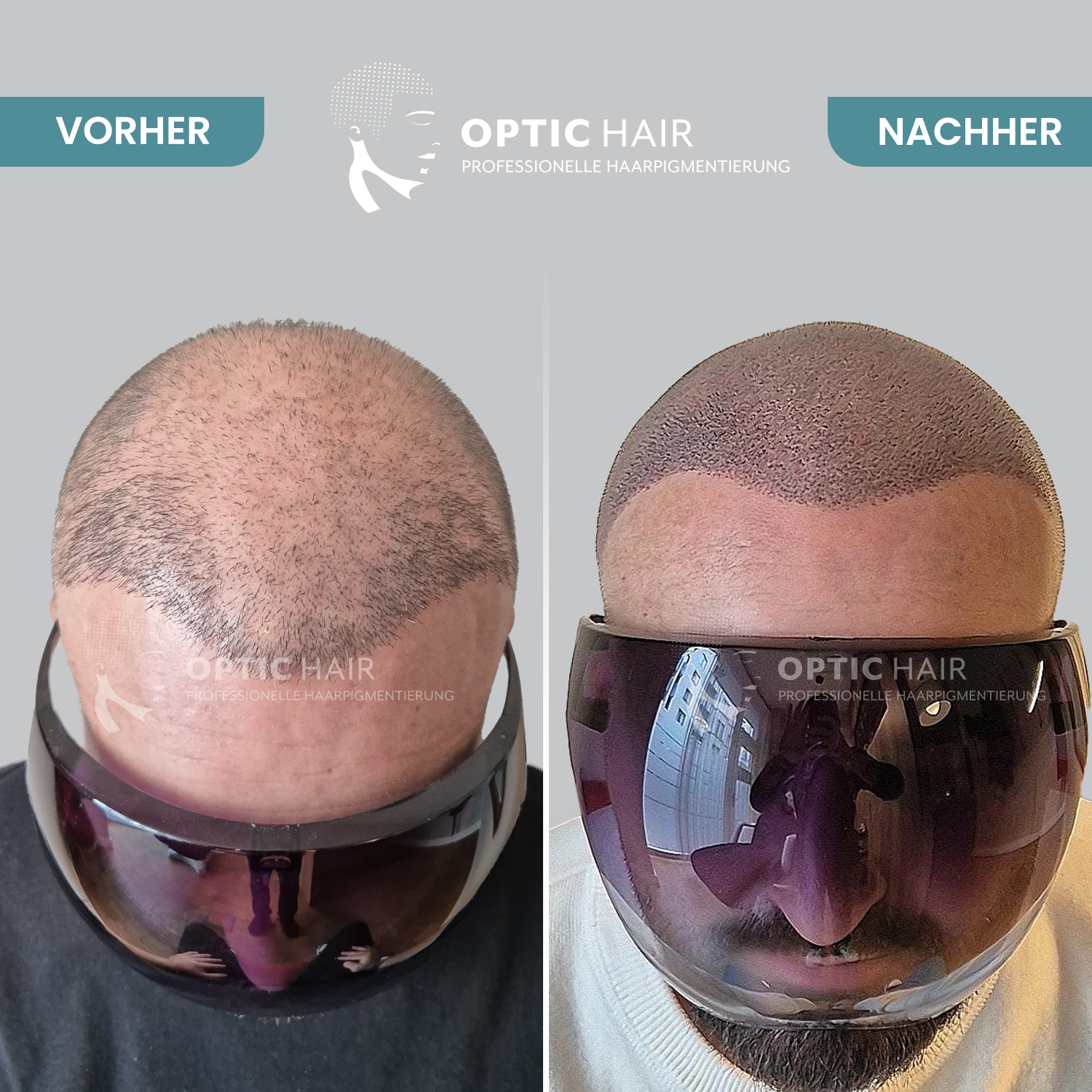 Kundenbild groß 4 Haarpigmentierung Köln | OpticHair