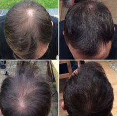 Images Capital Hair Restoration