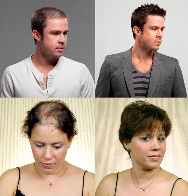 Images HRC Hair Restoration Of California