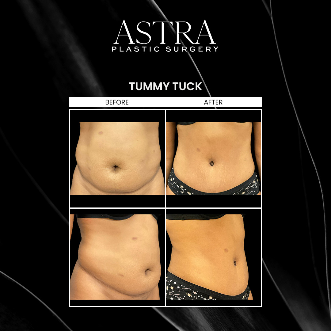 Tummy tuck surgery in Marietta, addresses excess abdominal fat and skin. Tummy tuck surgery removes stubborn pockets of fat following weight loss or pregnancy to achieve a flatter, toned midsection. Undergoing a tummy tuck can repair weakened or separated stomach muscles, improve contours, reduce skin irritation, and more.