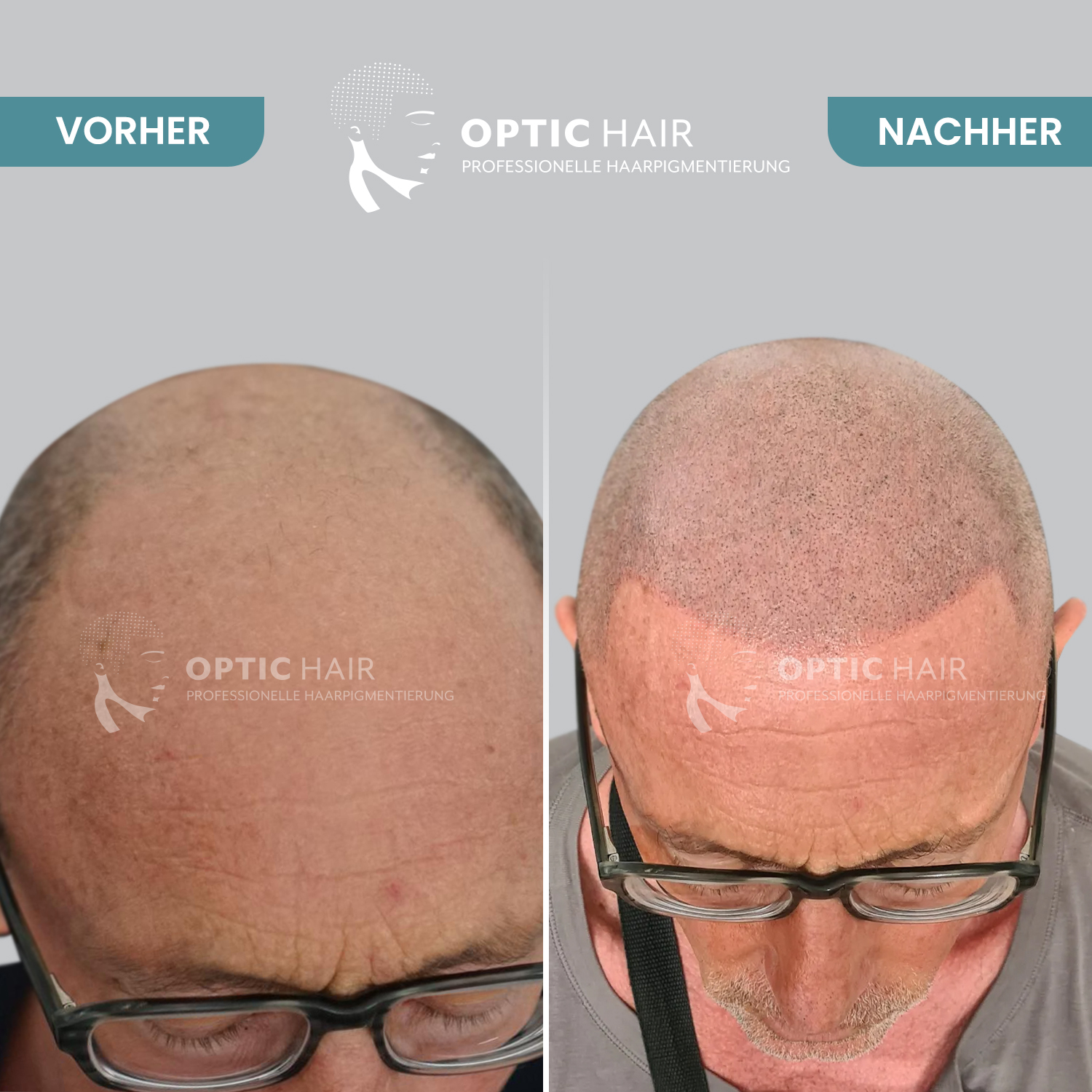 Kundenbild groß 15 Haarpigmentierung Köln | OpticHair
