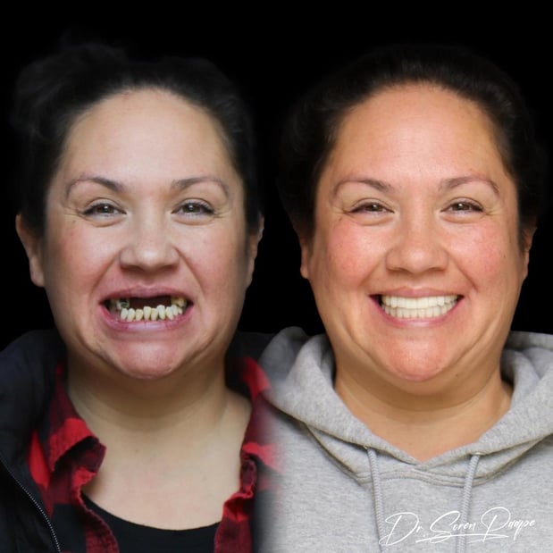 Images Smile Now Denver Dentures and Implants