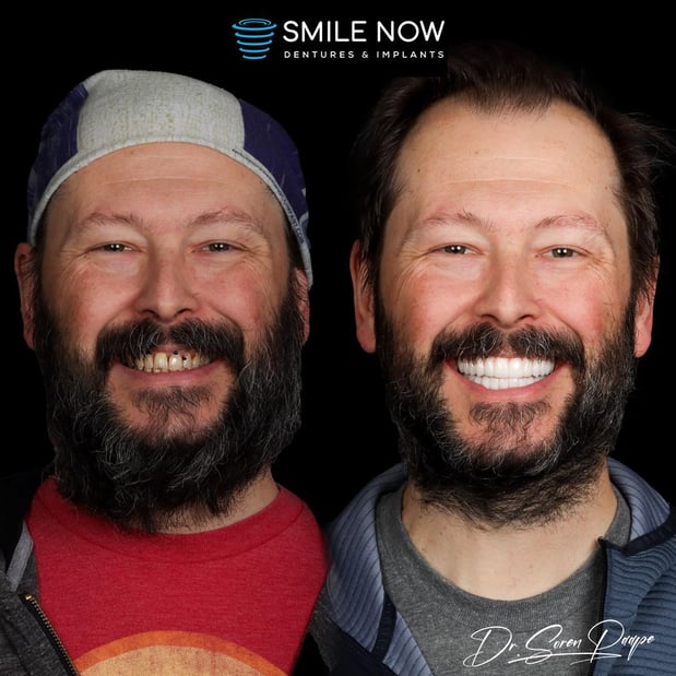 Images Smile Now Denver Dentures and Implants