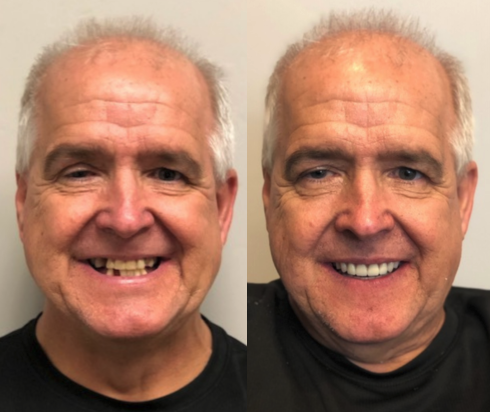 Before and After from Stubbs Dental | Layton, UT