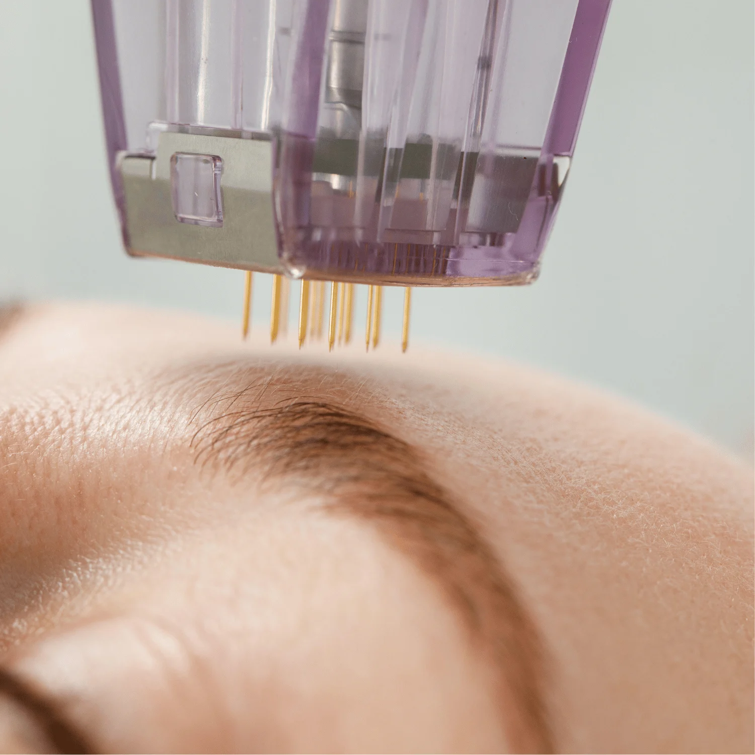 Close-up of a microneedling-style device with fine needles positioned above the forehead near the eyebrow.