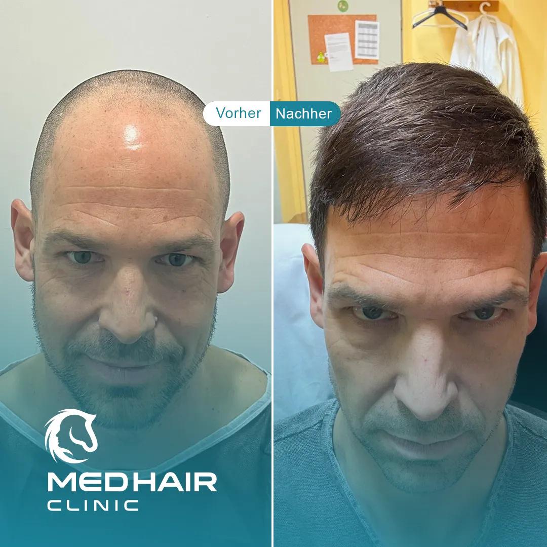 MedHair Clinic | Haartransplantationen in der Türkei Istanbul, Höninger Weg 176 in Rodenkirchen