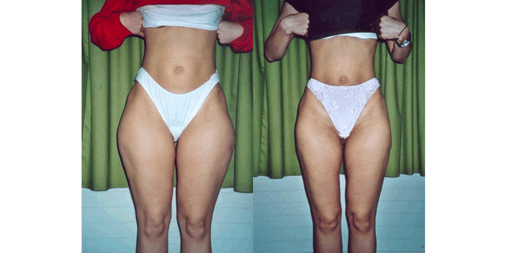 Bilder Medical Aesthetic Fettabsaugen Dr. Urs Benz