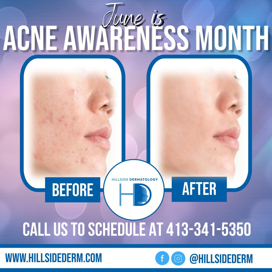 Hillside Dermatology provides the best and most affordable dermatology, acne treatment and atopic dermatitis in Agawam serving Western Massachusetts.