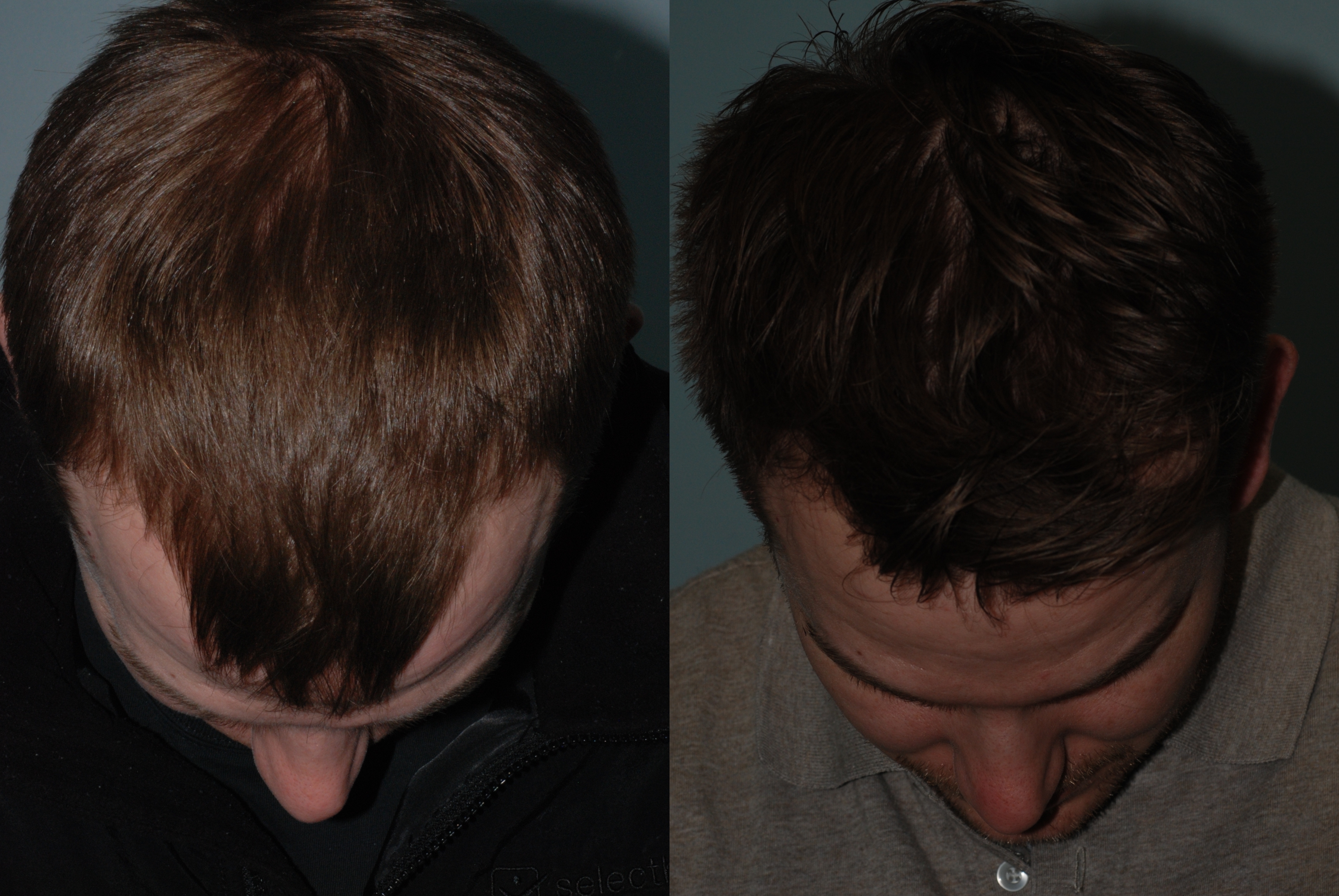Neograft FUE hair transplant before and one year later.