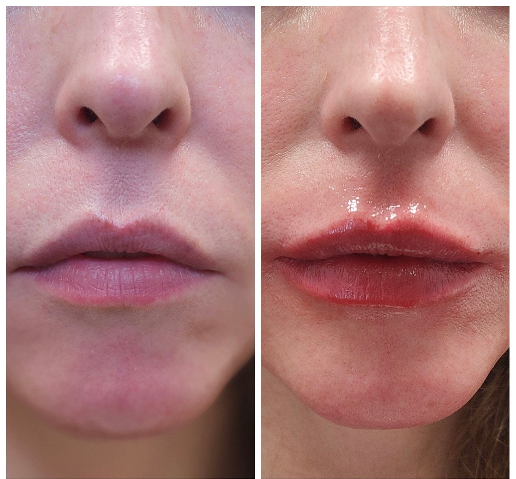 Lip enhancement before and after, Care Esthetics Delaware